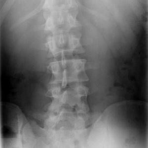 Escoliosis tratamiento quiropráctico - Quiropractic Llevant